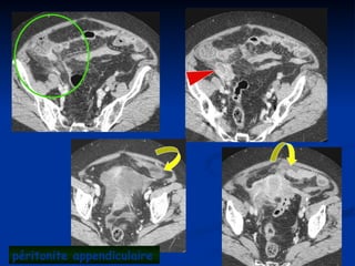 péritonite appendiculaire
 