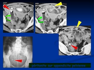 péritonite sur appendicite pelvienne
 