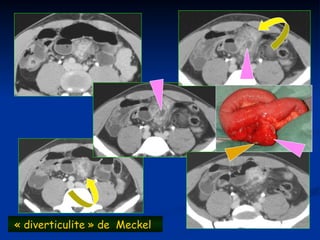 « diverticulite » de Meckel
 