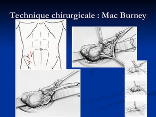 Technique chirurgicale : Mac Burney
Technique chirurgicale : Mac Burney
 
