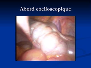 Abord coelioscopique
Abord coelioscopique
 