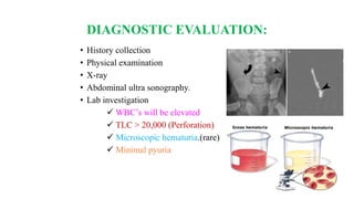 DIAGNOSTIC EVALUATION:
• History collection
• Physical examination
• X-ray
• Abdominal ultra sonography.
• Lab investigation
 WBC’s will be elevated
 TLC > 20,000 (Perforation)
 Microscopic hematuria.(rare)
 Minimal pyuria
 