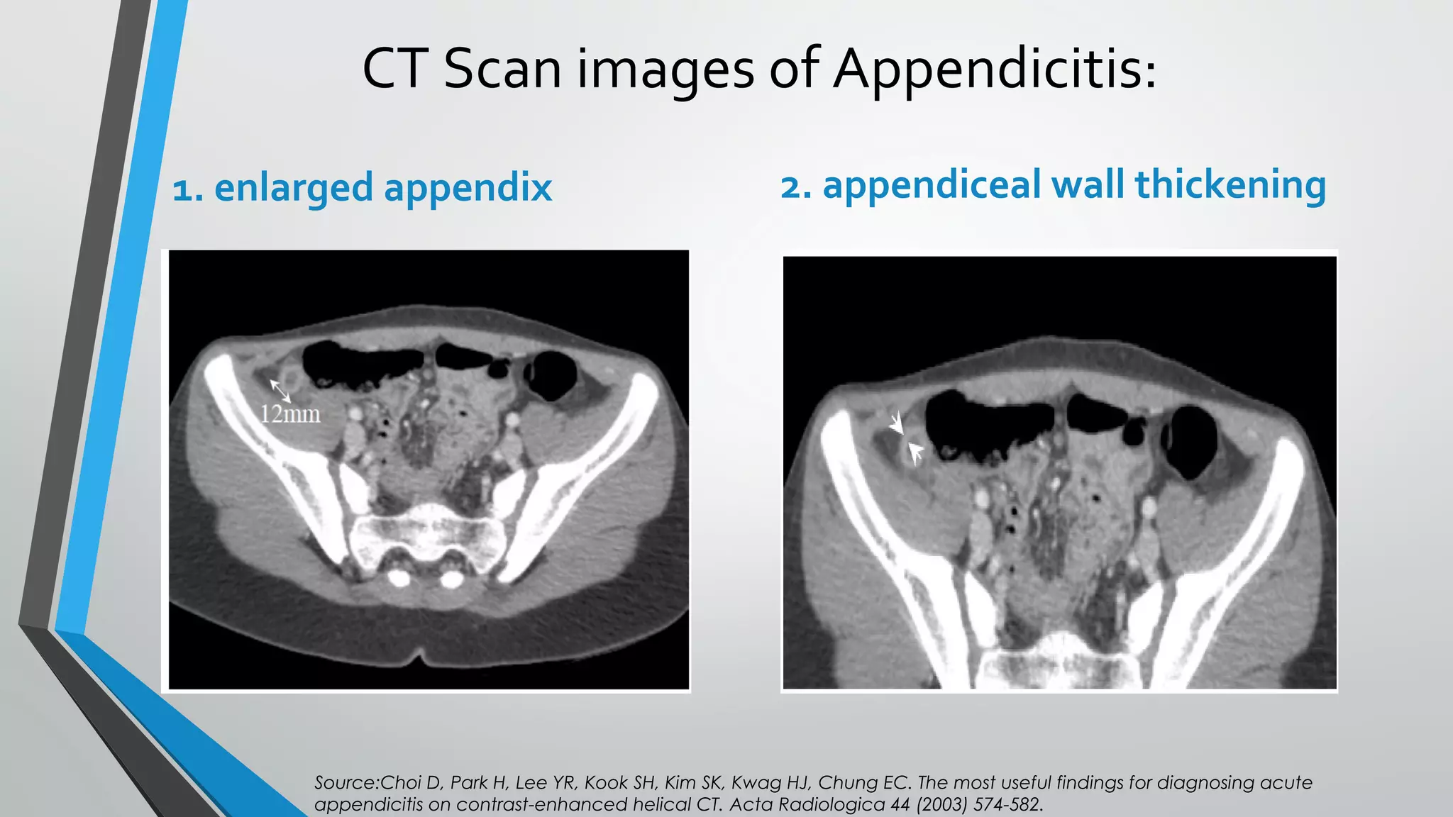 Appendicitis | PPT
