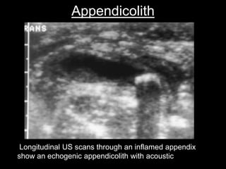 Appendicolith

Longitudinal US scans through an inflamed appendix
show an echogenic appendicolith with acoustic shadowing

 