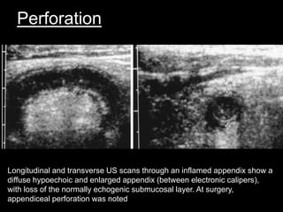 Perforation

Longitudinal and transverse US scans through an inflamed appendix show a
diffuse hypoechoic and enlarged appendix (between electronic calipers),
with loss of the normally echogenic submucosal layer. At surgery,
appendiceal perforation was noted

 