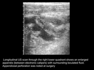 Longitudinal US scan through the right lower quadrant shows an enlarged
appendix (between electronic calipers) with surrounding loculated fluid.
Appendiceal perforation was noted at surgery

 