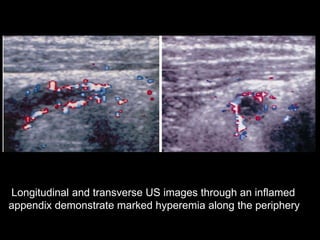 Longitudinal and transverse US images through an inflamed
appendix demonstrate marked hyperemia along the periphery

 