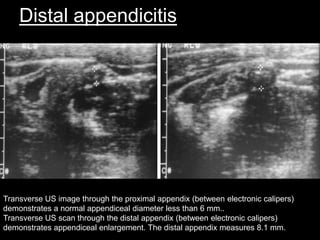 Distal appendicitis

Transverse US image through the proximal appendix (between electronic calipers)
demonstrates a normal appendiceal diameter less than 6 mm..
Transverse US scan through the distal appendix (between electronic calipers)
demonstrates appendiceal enlargement. The distal appendix measures 8.1 mm.

 