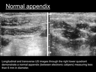 Normal appendix

Longitudinal and transverse US images through the right lower quadrant
demonstrate a normal appendix (between electronic calipers) measuring less
than 6 mm in diameter.

 