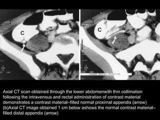 Axial CT scan obtained through the lower abdomenwith thin collimation
following the intravenous and rectal administration of contrast material
demonstrates a contrast material–filled normal proximal appendix (arrow)
(b)Axial CT image obtained 1 cm below ashows the normal contrast material–
filled distal appendix (arrow)

 