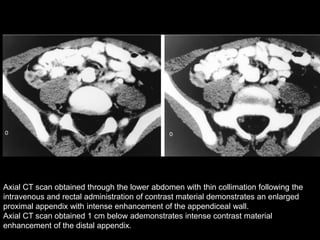 Axial CT scan obtained through the lower abdomen with thin collimation following the
intravenous and rectal administration of contrast material demonstrates an enlarged
proximal appendix with intense enhancement of the appendiceal wall.
Axial CT scan obtained 1 cm below ademonstrates intense contrast material
enhancement of the distal appendix.

 
