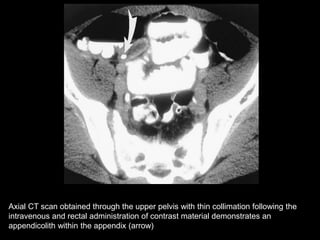 Axial CT scan obtained through the upper pelvis with thin collimation following the
intravenous and rectal administration of contrast material demonstrates an
appendicolith within the appendix (arrow)

 
