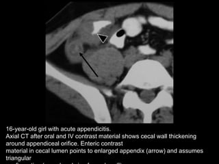 16-year-old girl with acute appendicitis.
Axial CT after oral and IV contrast material shows cecal wall thickening
around appendiceal orifice. Enteric contrast
material in cecal lumen points to enlarged appendix (arrow) and assumes
triangular

 