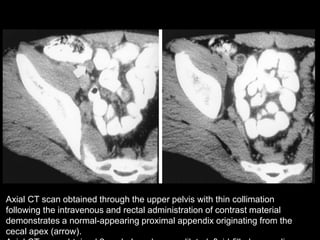 Axial CT scan obtained through the upper pelvis with thin collimation
following the intravenous and rectal administration of contrast material
demonstrates a normal-appearing proximal appendix originating from the
cecal apex (arrow).

 