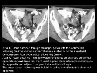 Axial CT scan obtained through the upper pelvis with thin collimation
following the intravenous and rectal administration of contrast material
demonstrates focal cecal apical thickening (arrow).
Axial CT scan obtained 1 cm below ademonstrates an enlarged curvilinear
appendix (arrow). Note that there is not a good plane of separation between
the appendix and adjacent unopacified small bowel loops.
The cecal apical thickening was helpful in calling attention to the abnormal
appendix.

 