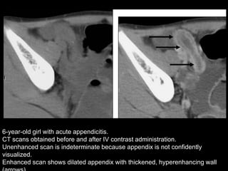 6-year-old girl with acute appendicitis.
CT scans obtained before and after IV contrast administration.
Unenhanced scan is indeterminate because appendix is not confidently
visualized.
Enhanced scan shows dilated appendix with thickened, hyperenhancing wall

 