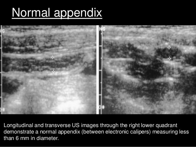 Imaging In Appendicitis