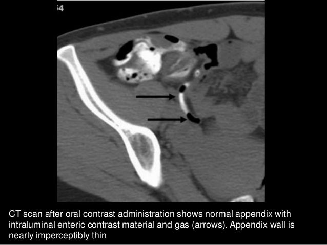much enema fluid how Imaging Appendicitis in