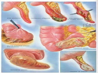 Appendicitis