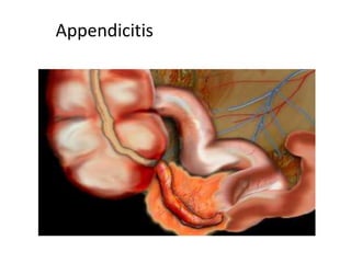 Appendicitis

 