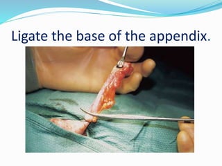 Appendicitis PPT By Dr Anil Kumar, Assist Professor,Gen Surgery, AIIMS ...