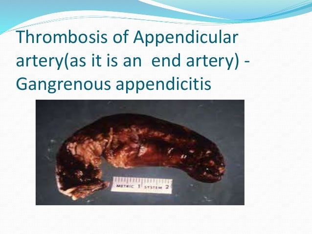 Appendicitis PPT By Dr Anil Kumar, Assist Professor,Gen Surgery, AIIM…