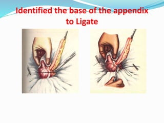 Appendicitis PPT By Dr Anil Kumar,Assist Prof( Gen Surgery) AIIMS ...