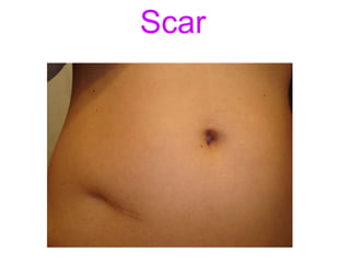 Scar
 
