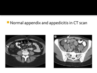 Appendicitis | PPT