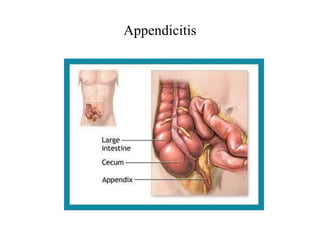 Appendicitis | PPTX