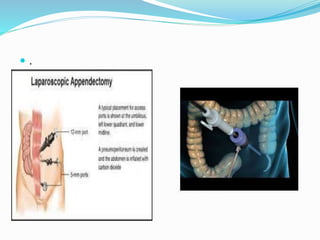 Appendix Endoscopy appendicitis-190528160323 (1).pdf