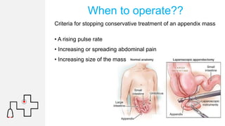 Appendicitis | PPTX