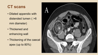 CT scans
• Dilated appendix with
distended lumen ( >6
mm diameter)
• Thickened and
enhancing wall
• Thickening of the caecal
apex (up to 80%)
 