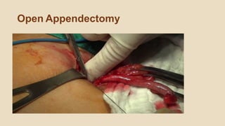 Open Appendectomy
 
