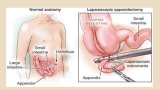 appendicitis-191217094731.pdf