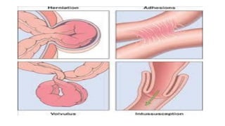 Appendicitis | PDF