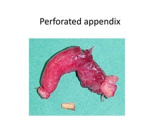 Perfed Appendix APPENDIcitis.pptx
