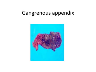 Angnesia Appendix APPENDIcitis.pptx