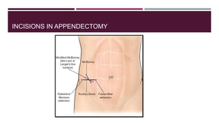 appendicitis.ppt