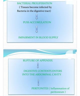 appendicitis.pdf