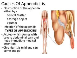 Appendicitis.pptx