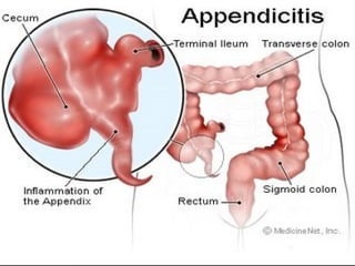 APPENDICITIS presentation notes for MDppt | PPT
