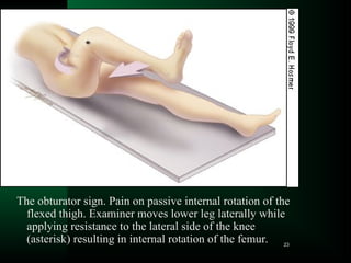Testing Obturator Sign APPENDICITIS presentation notes for MDppt | PPT