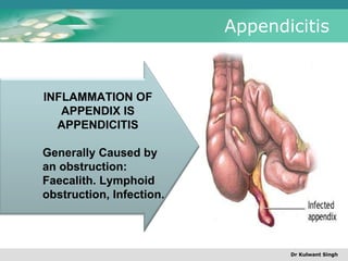 A P P E N D I C I T I S | PPT