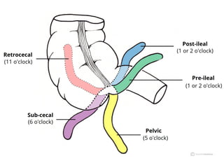 Perfed Appendix Appendicitis is the inflamation of apemdex | PPTX
