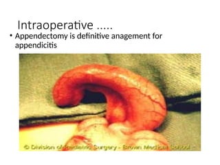 Appendicitis is the inflamation of apemdex | PPTX