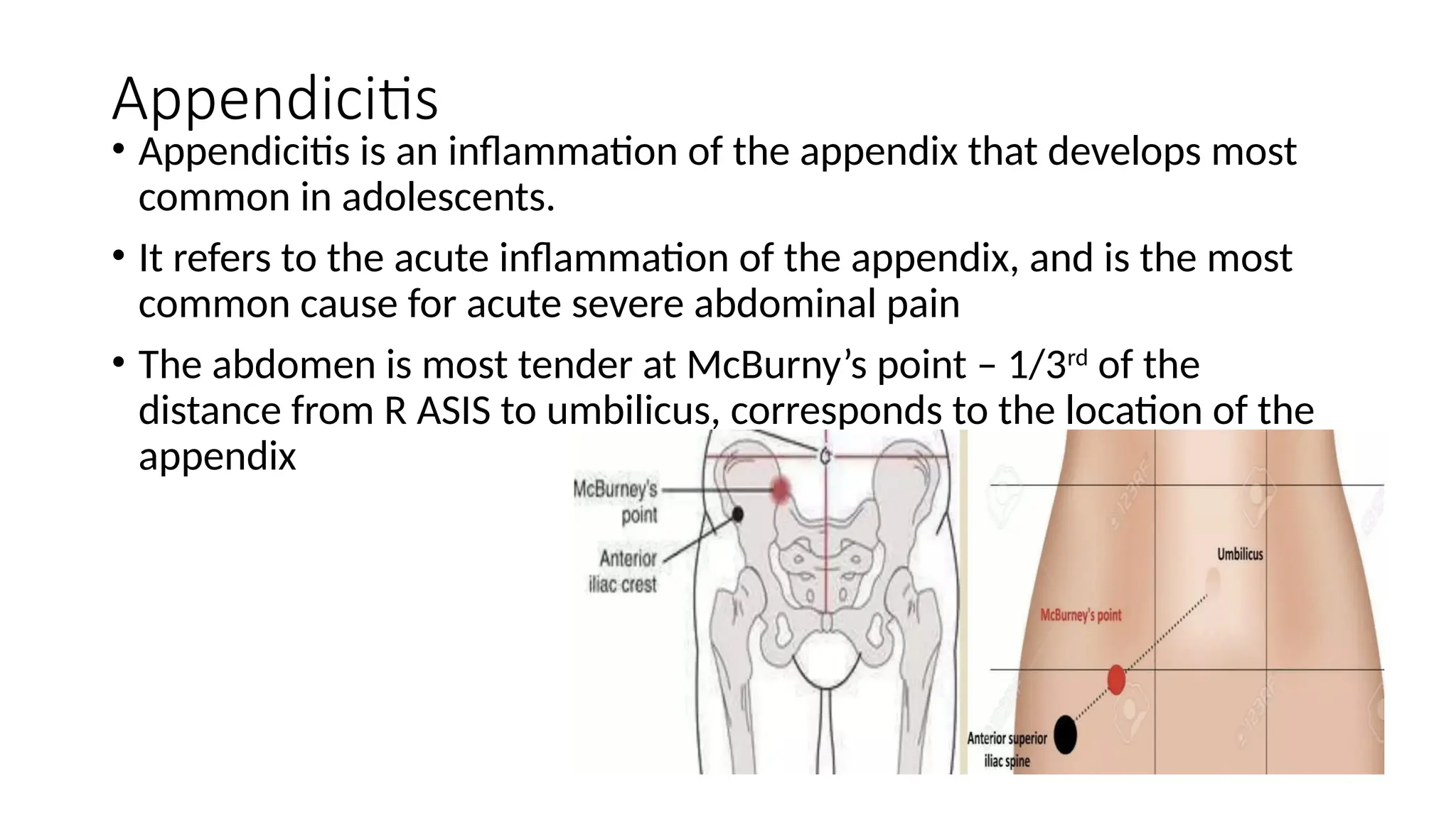 Appendix Pain Point Appendicitis and its complications asdpptx | PPTX