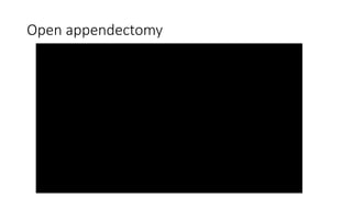 Open appendectomy
 