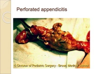 Perfed Appendix APPENDICITIS clinical sign symptoms and Management.ppt