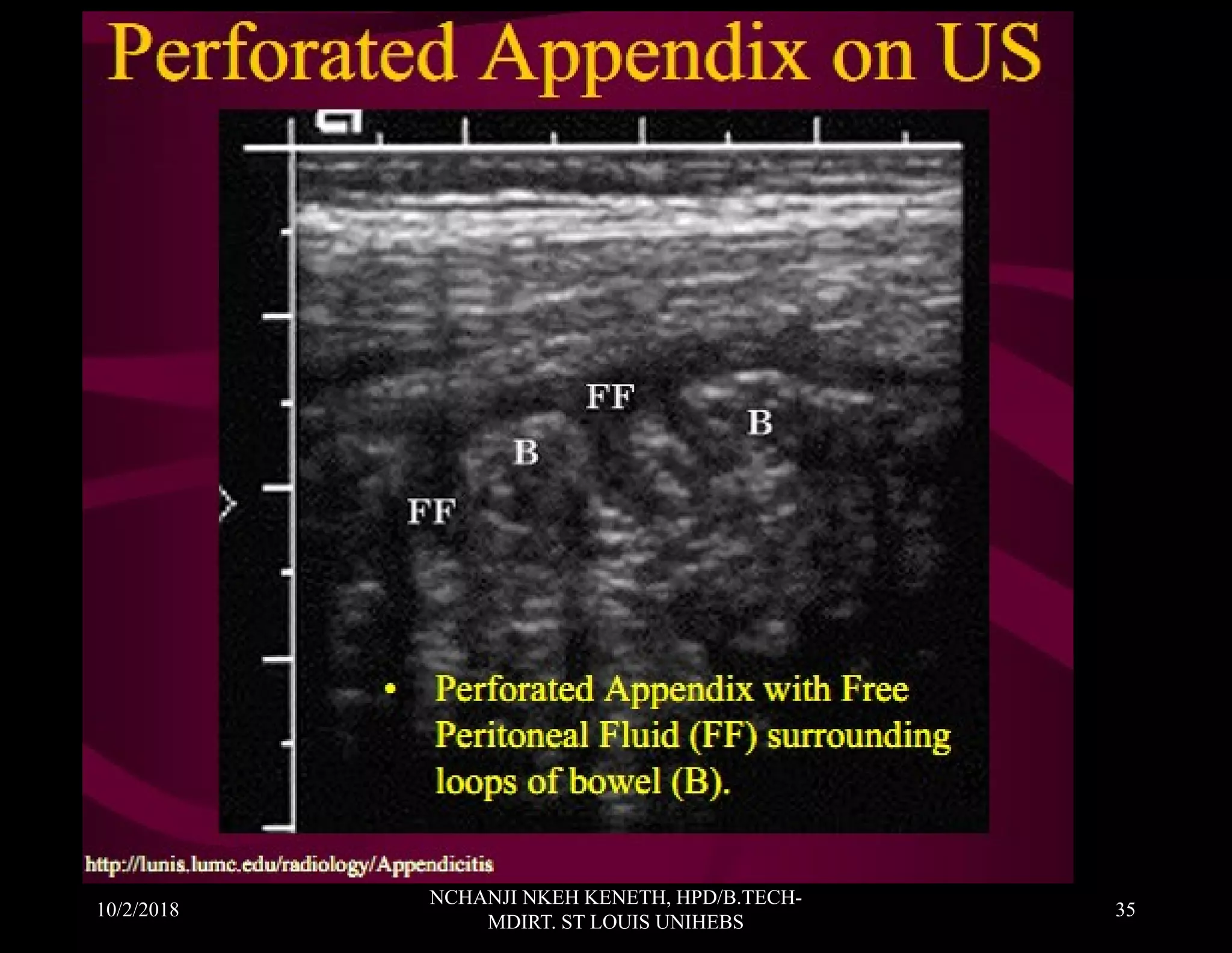 Appendicitis and role of ultrasound scan in diagnosis Nchanji Nkeh ...